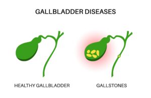 Gallbladder Diseases
