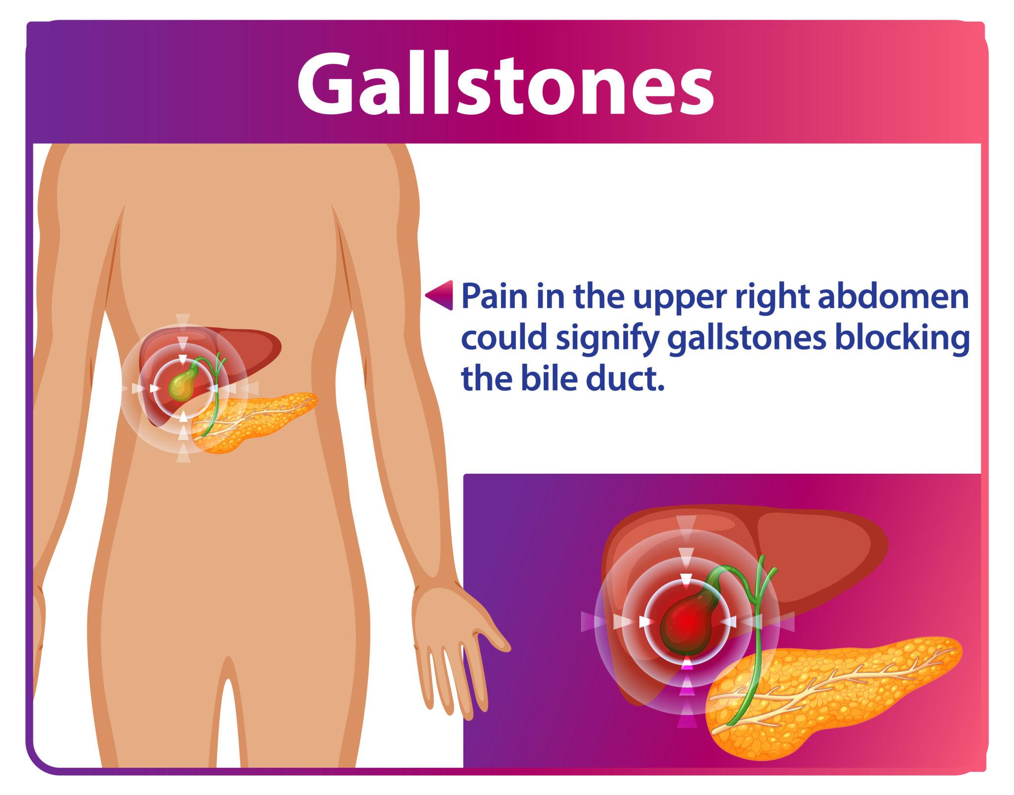 Gallbladder Stone Pain Area