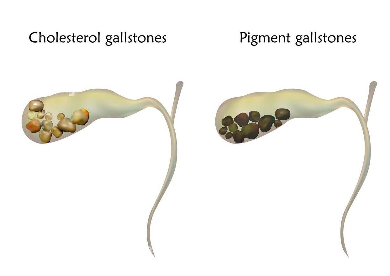 Types of Gallstones